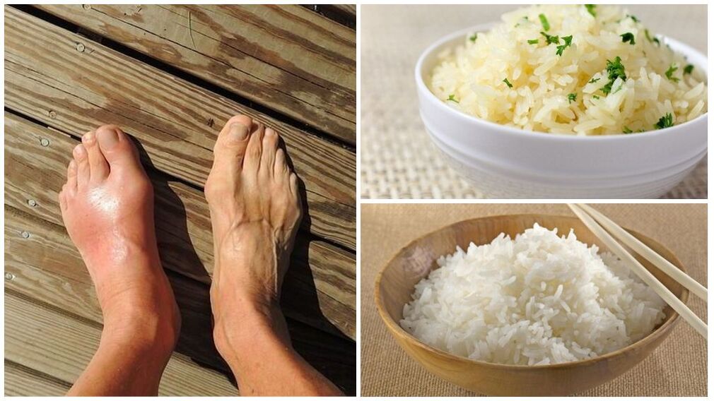 Pacijentima sa gihtom preporučuje se dijeta na bazi riže. 
